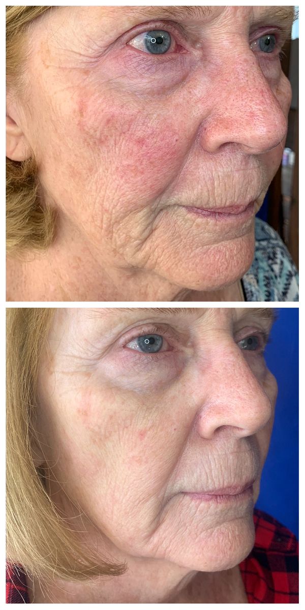 Plasma Skin Tightening